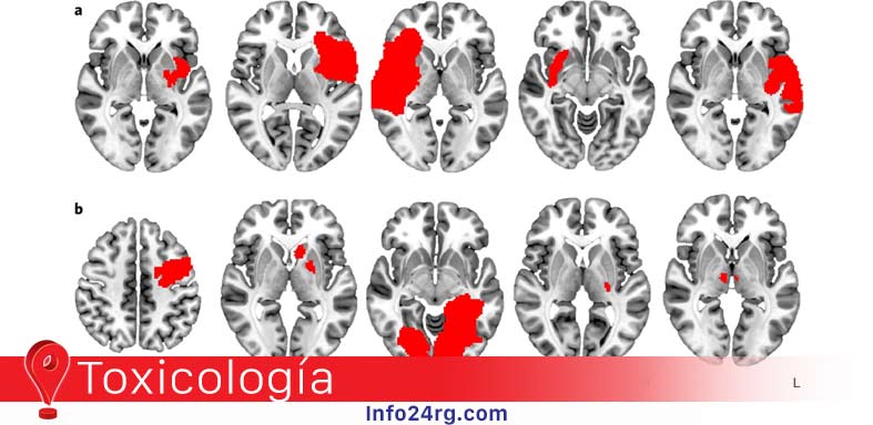 lesión cerebral 