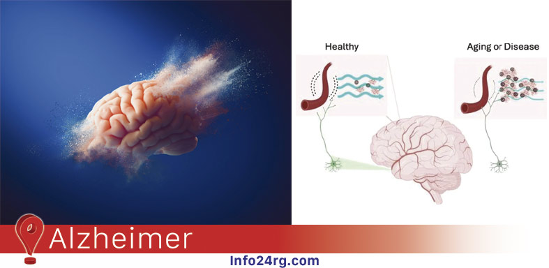 Alzheimer