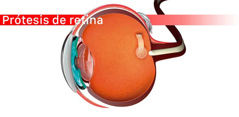 Esquema de una prótesis de retina con estimuladores de grafeno para transmitir información del exterior a través del nervio óptico. / ICN2